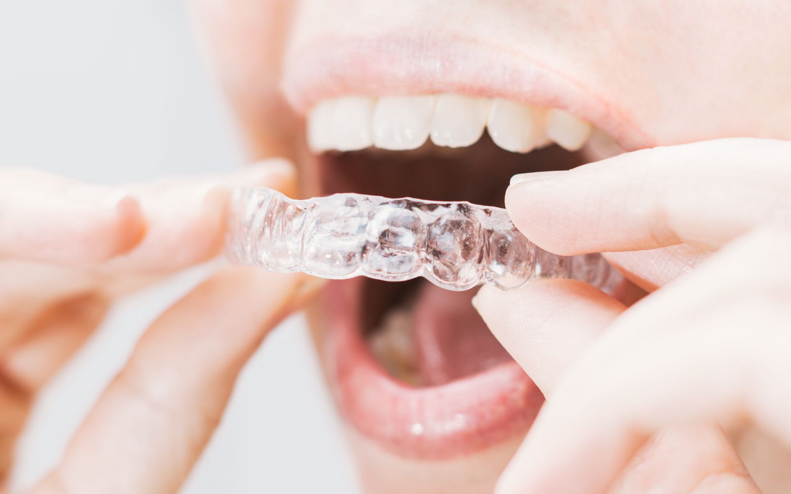Transparente Aligner-Schiene wird in den Oberkiefer eingesetzt