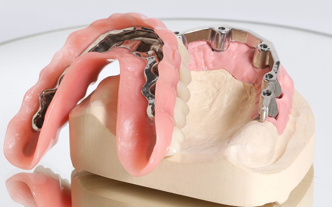 Herausnehmbare Prothese mit Metallgerüst neben dem Implantatsteg auf dem Arbeitsmodell